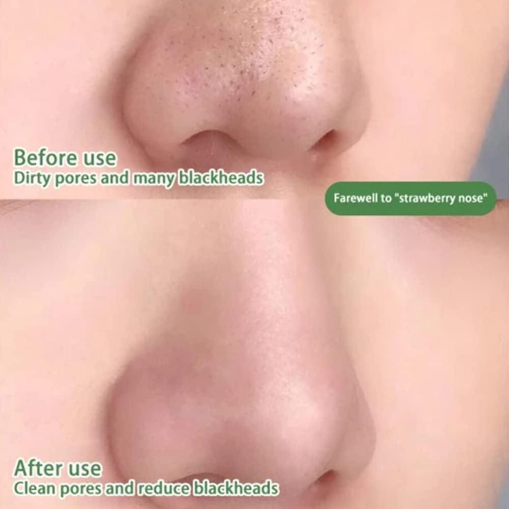 Zelena krema za aknasto kožo – formula za intenzivno čiščenje